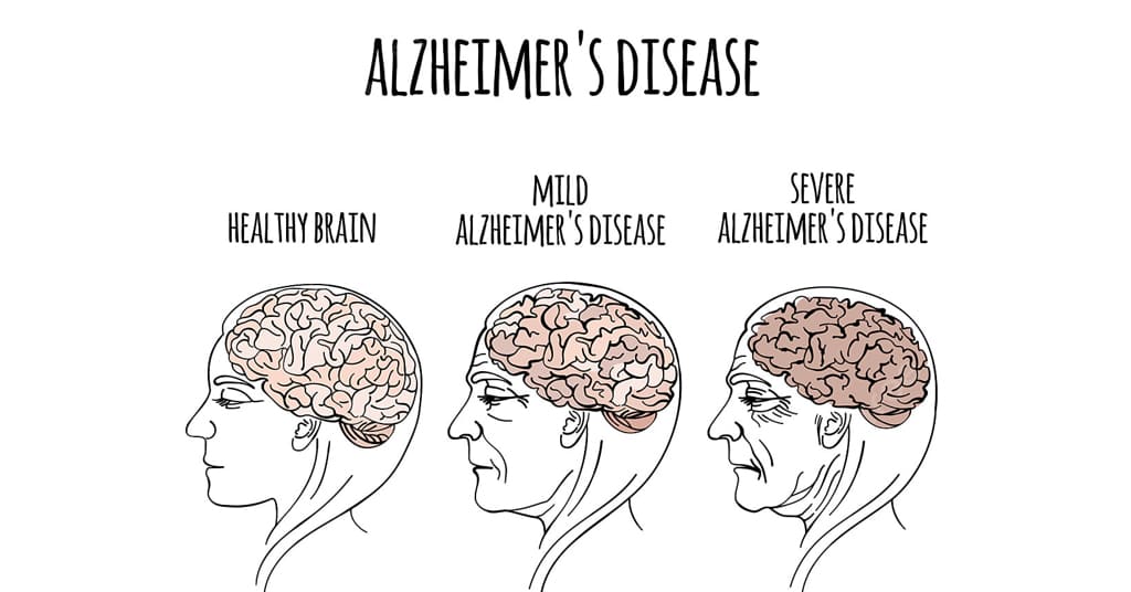 alzheimer disebabkan oleh pembentukan plak plak di otak