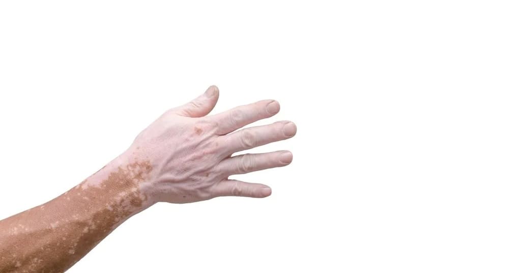 Penyakit Kulit Vitiligo Menular Atau Tidak