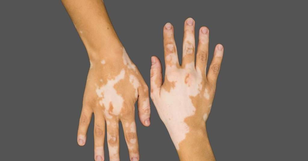 Cara Menghilangkan Vitiligo